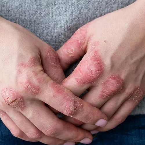 Leia mais sobre o artigo Dr. Murillo Dório responde dúvidas frequentes sobre a Artrite Psoriásica. Confira!